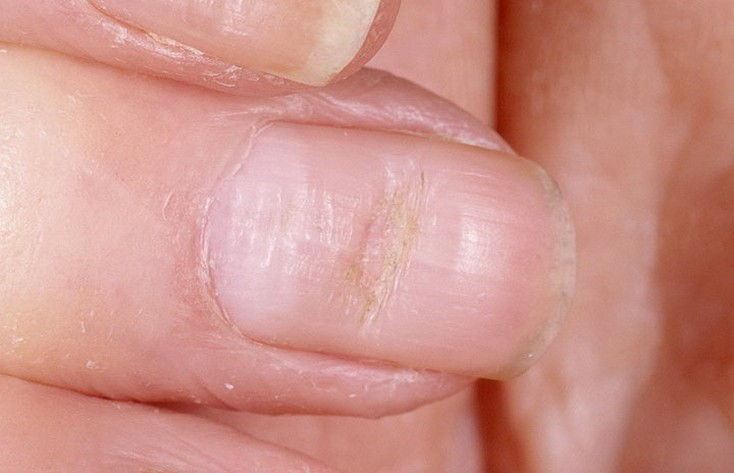 Факторы появления неровностей на ногтях